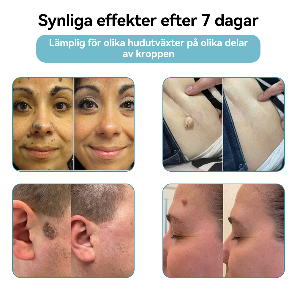 Bikenda® laserpenna🎉 – Säg hejdå till hudproblem med kraften av CO₂-laser!