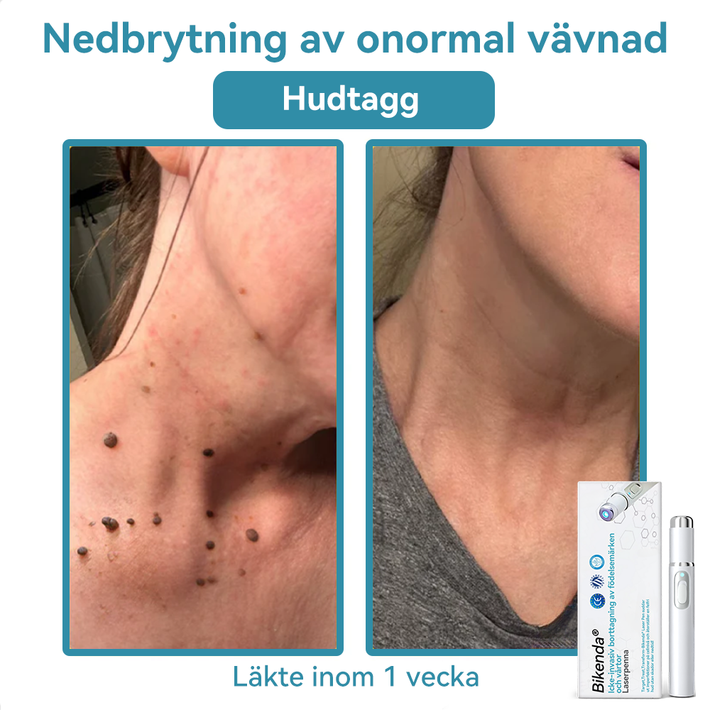 Bikenda® laserpenna🎉 – Säg hejdå till hudproblem med kraften av CO₂-laser!