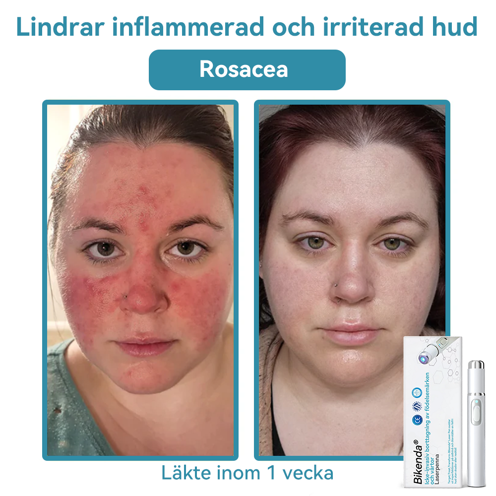 Bikenda® laserpenna🎉 – Säg hejdå till hudproblem med kraften av CO₂-laser!